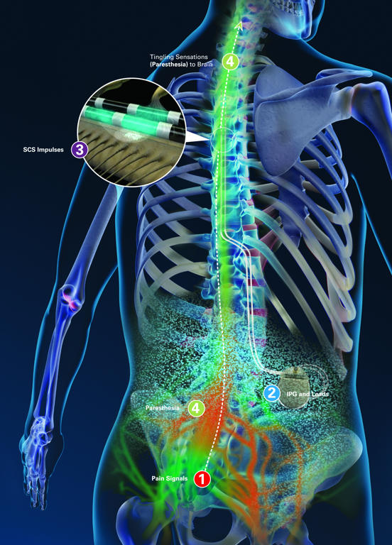 abbott primary cell spinal cord stimulation